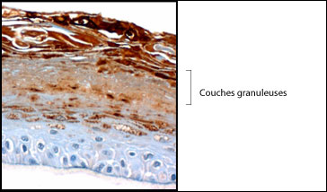 psoriasis04