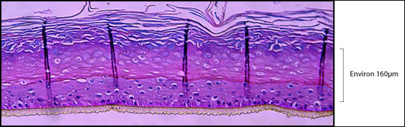 psoriasis02